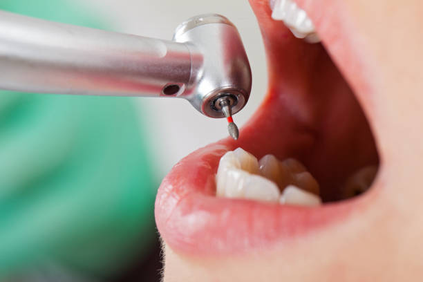 Best Knocked-Out Tooth (Avulsed Tooth) Treatment in Rush City, MN